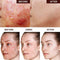 Anti-Acne crème