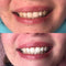 Premium Tandenbleekset – Stralend Witte Tanden