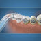 Waterpik OD-100 - Orthodontische Tips voor Waterflossers - Zachte haartjes - (2 stuks)